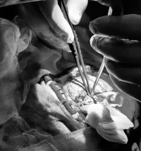 Чаллы табиблары 41 яшьлек хатын-кызны үлемнән коткарып калды