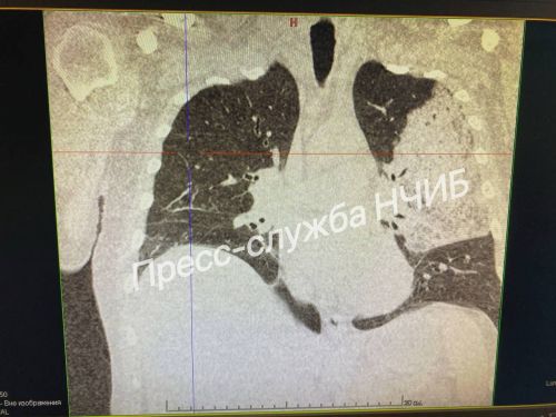 Чаллы табиблары пациентны коткардылар