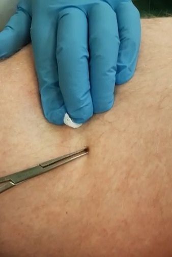 Талпаннан зыян күрүчеләр кимеде